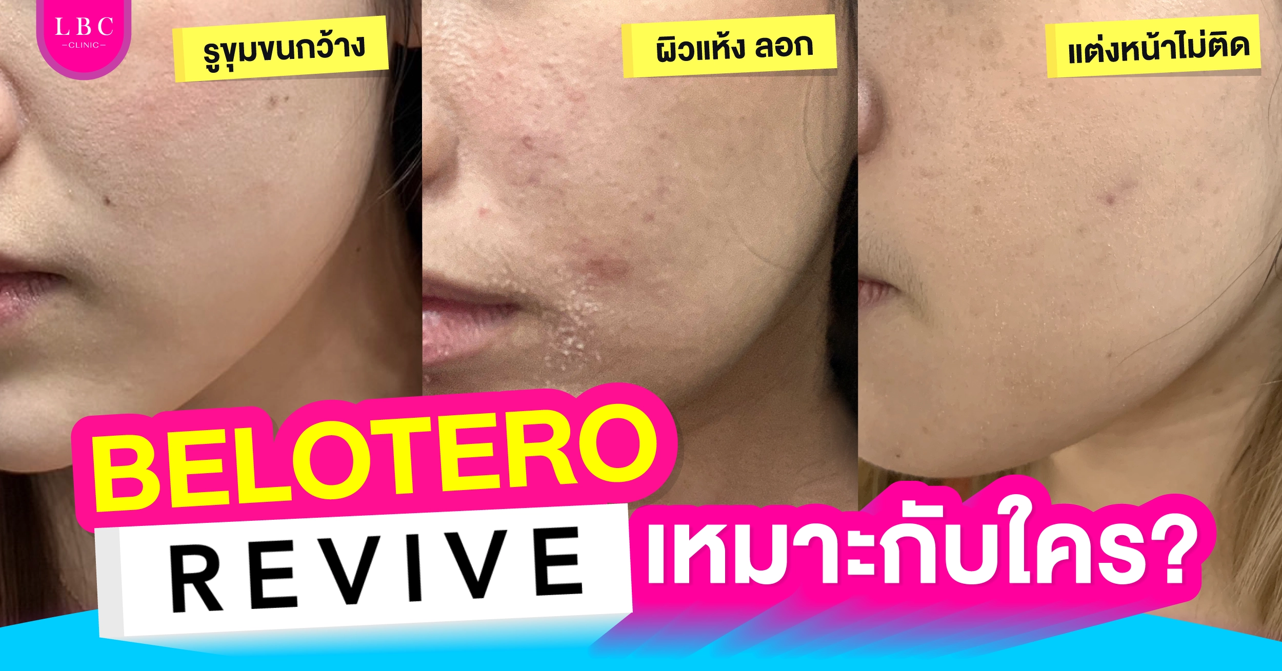 BELOTERO REVIVE ฟิลเลอร์นางฟ้า งานผิวหน้า 4 มิติ | LBC-Clinic.com